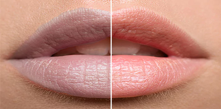 Reasons of lips hyperpigmentation
